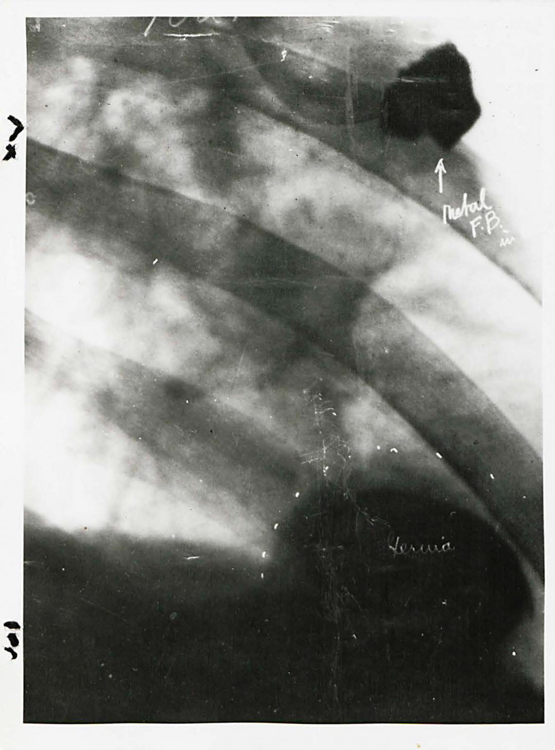 Shrapnel in lung x-rays on page 74